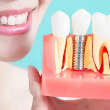 Which Dental Implant Brand Should I Choose