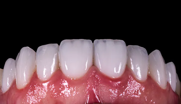 Dental Veneers Emax