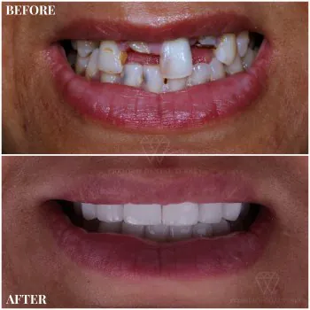 Dental Crowns patient premium dental turkey