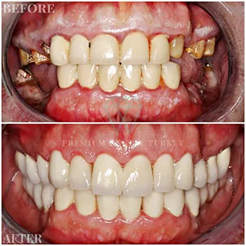 dental implants before after