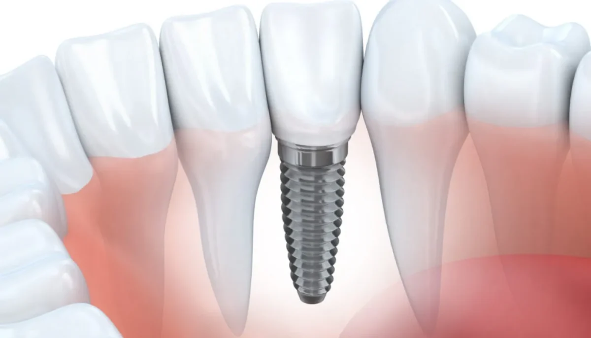 Dental Implants in Turkey
