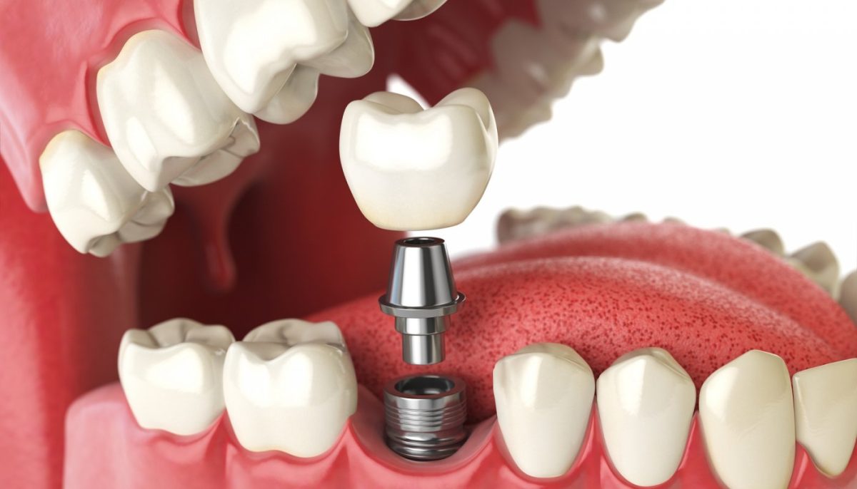 How to Fix Missing Teeth