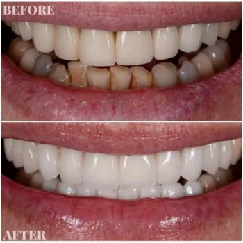 dental veneers in turkey before after