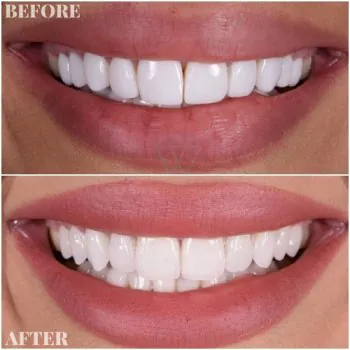 dental veneers in turkey before after