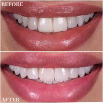 dental veneers in turkey before after