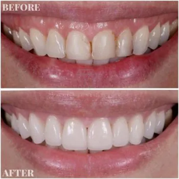 dental veneers in turkey before after