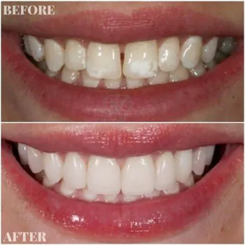 dental veneers in turkey before after