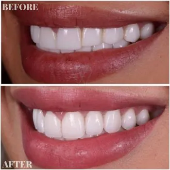 dental veneers in turkey before after