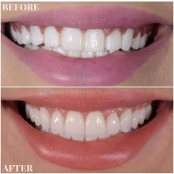 dental veneers in turkey before after