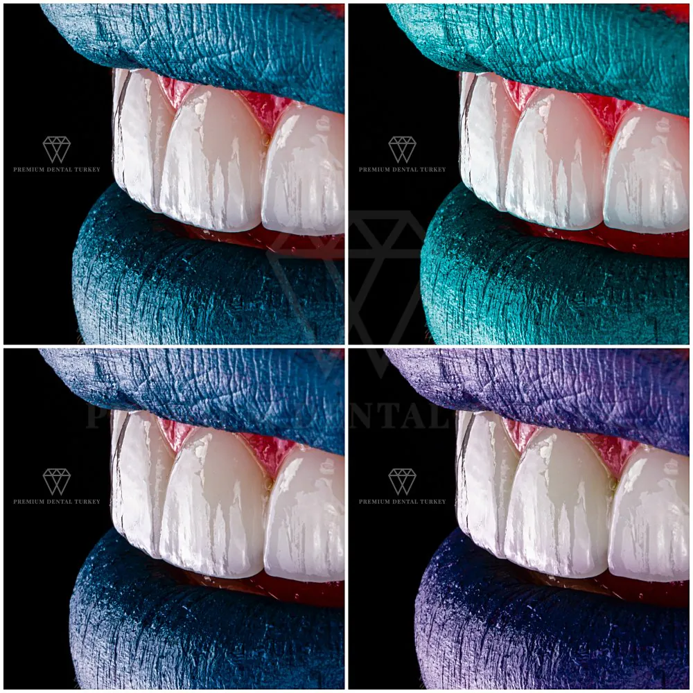 emax vs zirconia