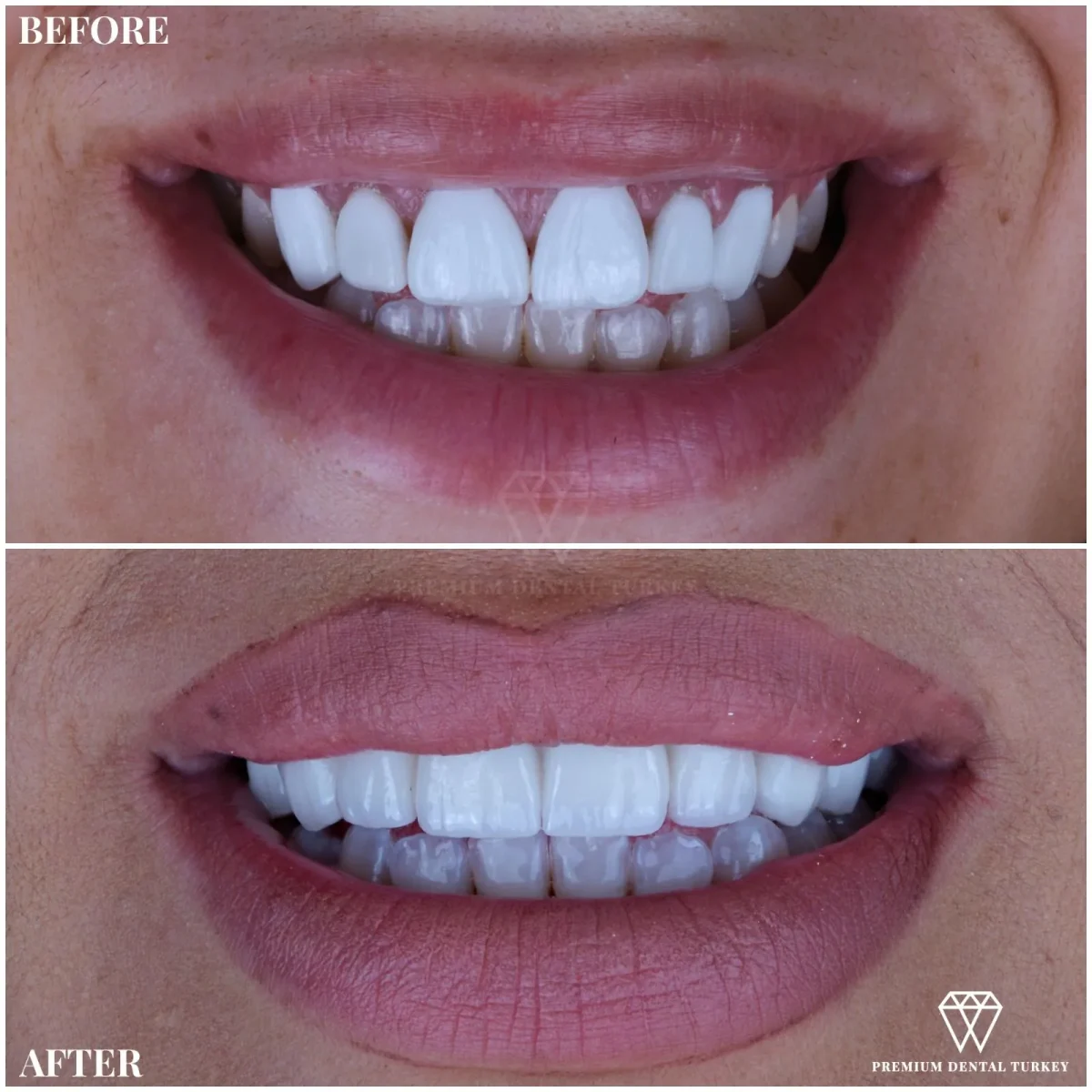 emax vs zirconia
