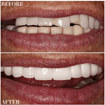 dental fillings in turkey