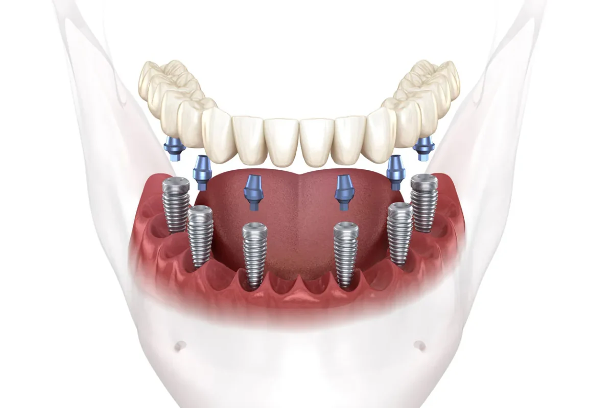 Full mouth Dental Implants Turkey