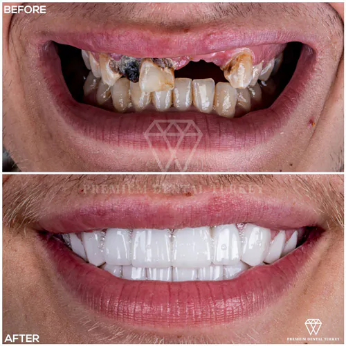 Full mouth dental implants in Turkey