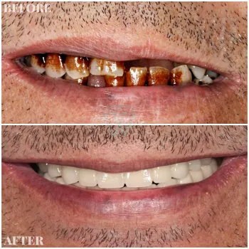 full mouth implants
