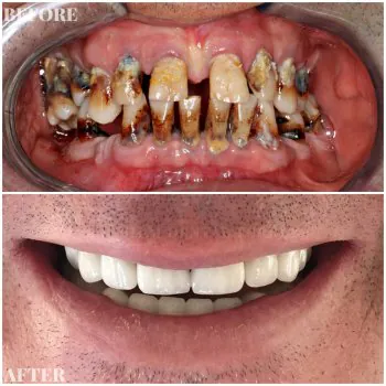 full mouth reconstruction turkey