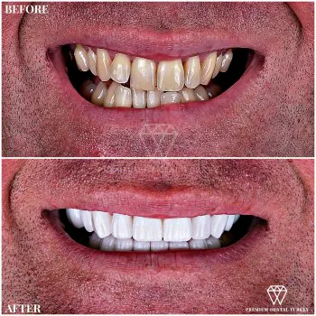 he visited premium dental turkey for before