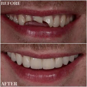 implants and veneers