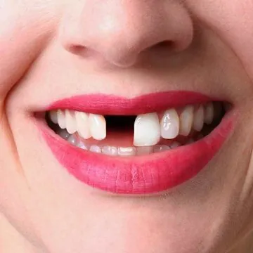 How to Fix Gaps Between Teeth