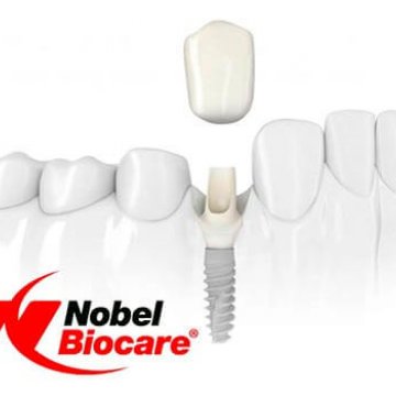 Which Dental Implant Brand Should I Choose