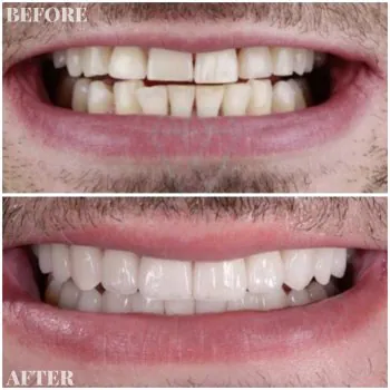 porcelain veneers