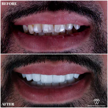 Premium Dental Turkey Veneers