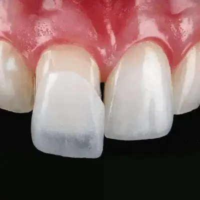 Set of Veneers