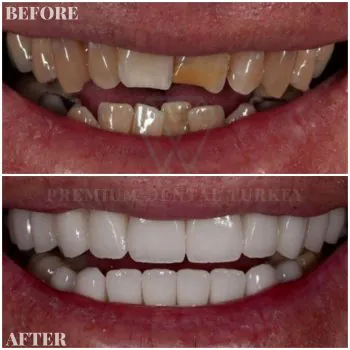 smile makeover