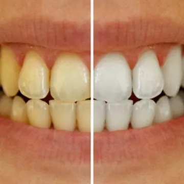 How to Fix Stained or Discoloured Teeth