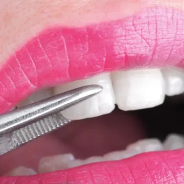 How to Straighten Teeth Without Braces