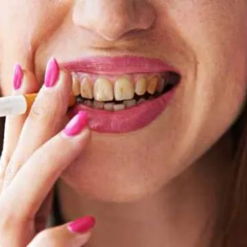How to Fix Stained or Discoloured Teeth