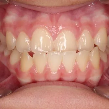 Understanding Bite Problems: From Causes to Solutions, and Exploring Dental Tourism in Turkey