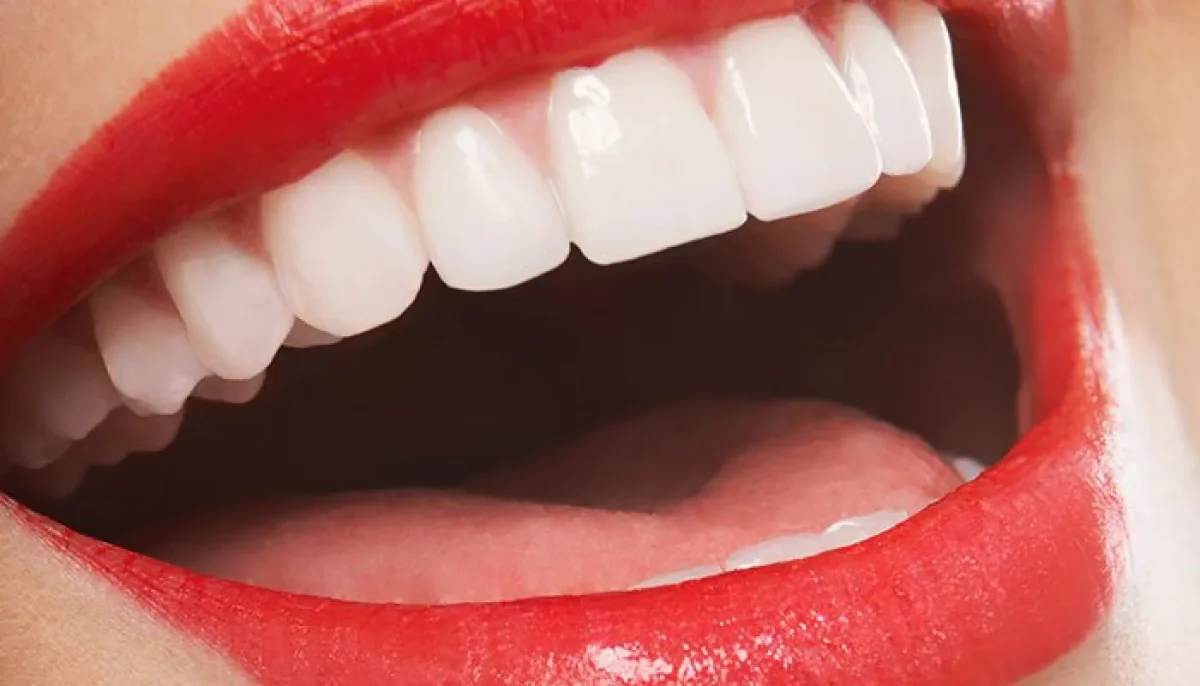 dental veneers abroad