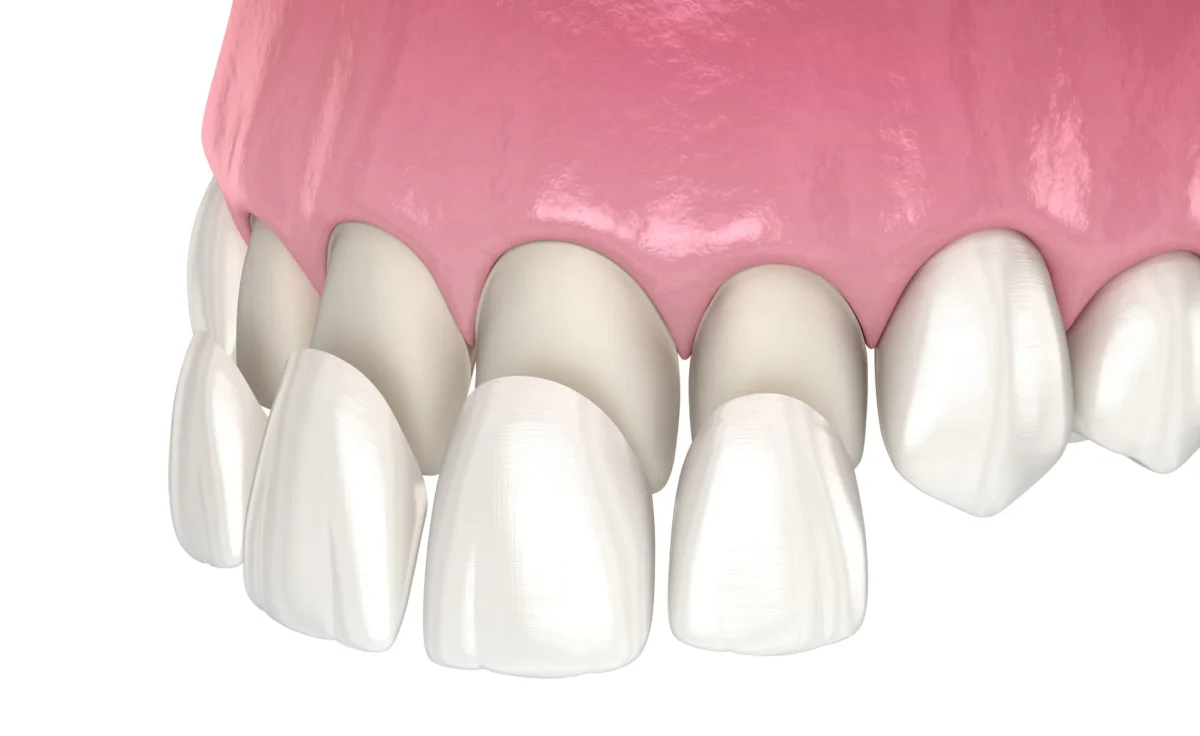 veneers in turkey