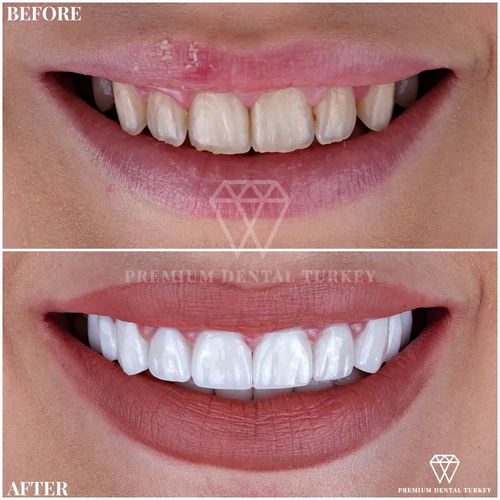 veneers-turkey-2024