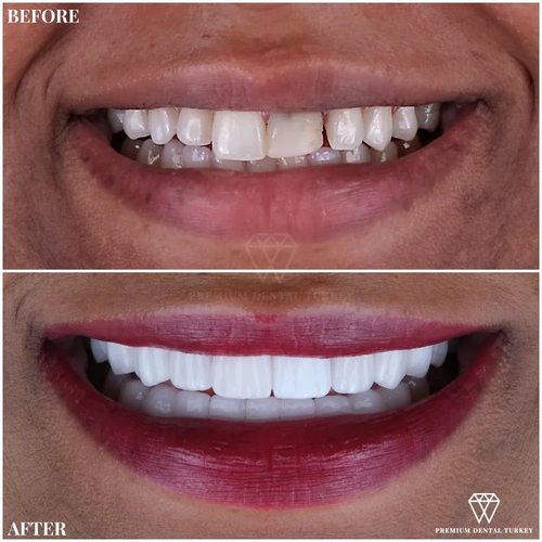 veneers in turkey