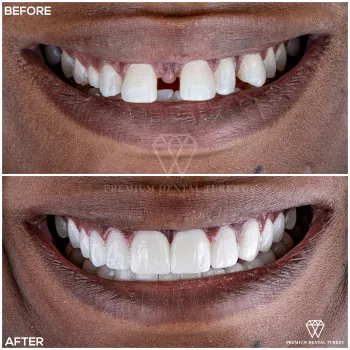 veneers before after