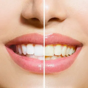 How to Fix Stained or Discoloured Teeth