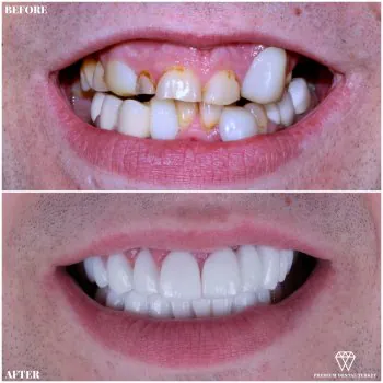 Dentist in turkey zirconium crowns