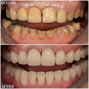 zirconium crowns turkey