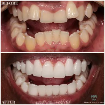 zirconium dental crowns in turkey