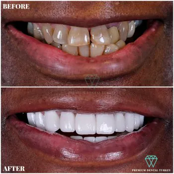 zirconium crowns