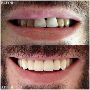 zirconium veneers turkey