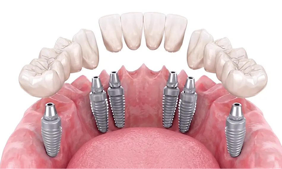 3 on 6 Dental Implants