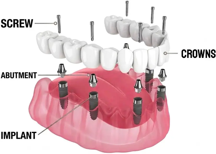 All on 6 Dental Implant Structure