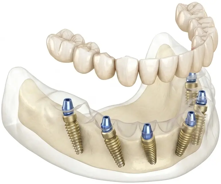 All on 6 Dental Implants