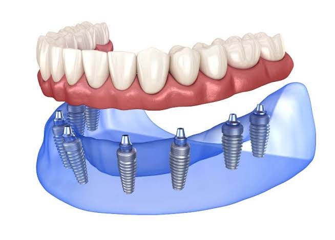 All-on-8 Dental Implants