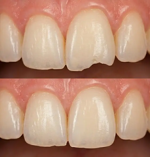 Composite Bonding Turkey