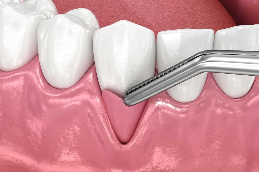 Gum Graft in Turkey Treatment