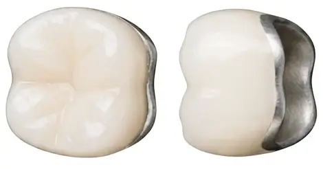 Metal porcelain crowns